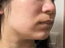 ポテンツァ 日比谷セントラルクリニック DAY 0 サムネイル用