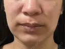 オンダリフト RIVER CLINIC（リバークリニック） AFTER サムネイル用
