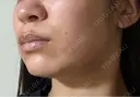 オンダリフト RIVER CLINIC（リバークリニック） DAY 109 サムネイル用