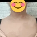 ボトックス（肩） DAILY SKIN CLINIC 福岡院 DAY 1 サムネイル用