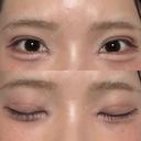 二重埋没 / 目頭切開 / 上まぶたの脂肪取り / ヒアルロン酸注入（涙袋） アリエル美容クリニック 郡山院 DAY 28 サムネイル用