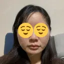 糸リフト / 脂肪吸引（顔） / 下まぶたの脂肪取り / 脂肪注入（額） / メーラーファット除去 / 脂肪注入（目の下） SEA CLINIC（シークリニック） AFTER サムネイル用