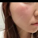 ルメッカ ルラ美容クリニック 札幌本院 DAY 0 サムネイル用
