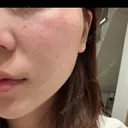 ルメッカ ルラ美容クリニック 札幌本院 DAY 0 サムネイル用