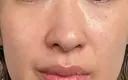 ルメッカ / LDM・インテンスウルトラ Chloe Cheongdam Clinic （クロエチョンダムクリニック） AFTER サムネイル用