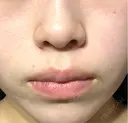 ほくろ・いぼ除去レーザー（肌） ルラ美容クリニック 大宮院 / ルラスキンクリニック 大宮院 DAY 131 サムネイル用