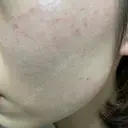 ルメッカ / LDM・インテンスウルトラ Chloe Cheongdam Clinic （クロエチョンダムクリニック） DAY 2 サムネイル用