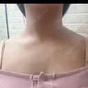 ボトックス（肩） DAILY SKIN CLINIC 福岡院 DAY 2 サムネイル用