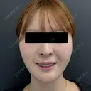 糸リフト / 脂肪吸引（顔） / メーラーファット除去 / ジョールファット除去 BLINC CLINIC （ブリンク クリニック） AFTER サムネイル用