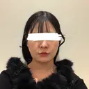 脂肪吸引（顔） ルラ美容クリニック 新宿院 DAY 28 サムネイル用