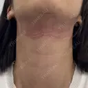 RF（高周波）たるみ治療 / インモード 東京美容皮膚科アロエクリニック池袋 DAY 0 サムネイル用