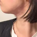 RF（高周波）たるみ治療 / インモード 東京美容皮膚科アロエクリニック池袋 DAY 0 サムネイル用