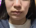 ポテンツァ 日比谷セントラルクリニック AFTER サムネイル用