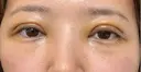 眼瞼下垂（切開） / 下まぶたたるみ取り WOM CLINIC GINZA （ワム クリニック ギンザ） DAY 3 サムネイル用