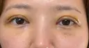 眼瞼下垂（切開） / 下まぶたたるみ取り WOM CLINIC GINZA （ワム クリニック ギンザ） DAY 4 サムネイル用