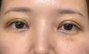 眼瞼下垂（切開） / 下まぶたたるみ取り WOM CLINIC GINZA （ワム クリニック ギンザ） DAY 5 サムネイル用