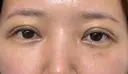 眼瞼下垂（切開） / 下まぶたたるみ取り WOM CLINIC GINZA （ワム クリニック ギンザ） DAY 6 サムネイル用