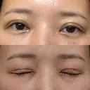 眼瞼下垂（切開） / 下まぶたたるみ取り WOM CLINIC GINZA （ワム クリニック ギンザ） DAY 7 サムネイル用