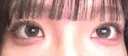二重埋没 アリエル美容クリニック 水戸院 DAY 14 サムネイル用