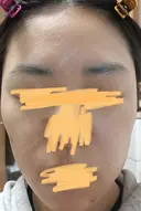 肌育注射（ジュベルックなど） LA MER CLINIC DAY 48 サムネイル用