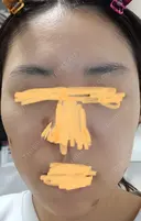 肌育注射（ジュベルックなど） LA MER CLINIC DAY 49 サムネイル用