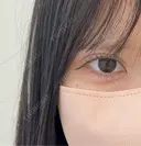 二重埋没 / ヒアルロン酸注入（涙袋） アリエル美容クリニック 大宮院 DAY 11 サムネイル用