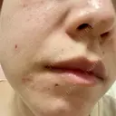 ほくろ・いぼ除去レーザー（肌） / ピコスポット Fellez Clinic【フェルズクリニック】 DAY 1 サムネイル用