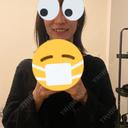 小鼻縮小（切開） / 脂肪注入（額） ASTRA BEAUTY CLINIC AFTER サムネイル用