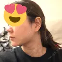 糸リフト / 脂肪吸引（顔） 4Dクリニック DAY 23 サムネイル用
