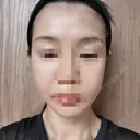 ボトックス（エラ・小顔） 品川美容外科 仙台院 DAY 1 サムネイル用