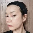 ボトックス（エラ・小顔） 品川美容外科 仙台院 DAY 1 サムネイル用