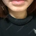 シミ取りレーザー 新宿美容外科クリニック 新宿院 AFTER サムネイル用