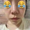 ほくろ・いぼ除去レーザー（肌） / ピコスポット Fellez Clinic【フェルズクリニック】 DAY 2 サムネイル用