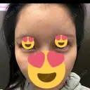 ヒアルロン酸注入（涙袋） / ヒアルロン酸注入（頬） / ヒアルロン酸注入（こめかみ） PRISM Beauty Clinic 新宿院 DAY 0 サムネイル用