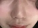ピーリング（ニキビ・毛穴） / 光治療（フォトフェイシャルなど） 銀座TSUBAKIクリニック AFTER サムネイル用