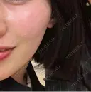ピーリング（ニキビ・毛穴） / 光治療（フォトフェイシャルなど） 銀座TSUBAKIクリニック DAY 105 サムネイル用