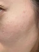 ルメッカ / LDM・インテンスウルトラ Chloe Cheongdam Clinic （クロエチョンダムクリニック） DAY 5 サムネイル用