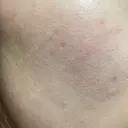ルメッカ / LDM・インテンスウルトラ Chloe Cheongdam Clinic （クロエチョンダムクリニック） DAY 5 サムネイル用