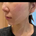 ルメッカ ルラ美容クリニック 札幌本院 DAY 6 サムネイル用