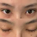 二重埋没 / 目頭切開 / 上まぶたの脂肪取り アリエル美容クリニック 郡山院 DAY 29 サムネイル用