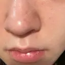 ピーリング（ニキビ・毛穴） / 光治療（フォトフェイシャルなど） / ピーリング（ハリ・ツヤ） DAILY SKIN CLINIC 新宿院 AFTER サムネイル用
