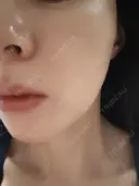 ルメッカ ルラ美容クリニック 新潟院 AFTER サムネイル用
