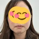 ボトックス（あご） / ボトックス（エラ・小顔） / ボトックス（口角） / RF（高周波）たるみ治療 ベールクリニック DAY 1 サムネイル用