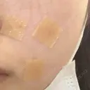 ほくろ・いぼ切除（肌） 美容皮膚科エルムクリニック 大阪院 AFTER サムネイル用