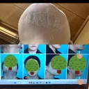 糸リフト / 骨切り（あご） / 脂肪吸引（顔） 銀座マイアミ美容外科 DAY 394 サムネイル用