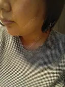 脂肪溶解注射（顔） 上野注入クリニック DAY 3 サムネイル用