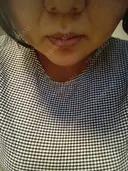 脂肪溶解注射（顔） 上野注入クリニック DAY 3 サムネイル用