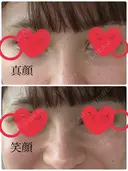 ボトックス（あご） / 脂肪溶解注射（顔） / ボトックス（目尻） TCB東京中央美容外科 高崎院 DAY 13 サムネイル用