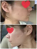 ボトックス（あご） / 脂肪溶解注射（顔） / ボトックス（目尻） TCB東京中央美容外科 高崎院 DAY 13 サムネイル用