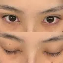 二重埋没 / 目頭切開 / 上まぶたの脂肪取り アリエル美容クリニック 郡山院 DAY 35 サムネイル用
